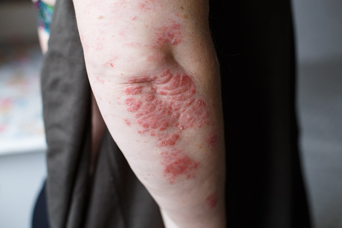 What Autoimmune Disease Causes Itchy Skin Without Rash - Printable ...